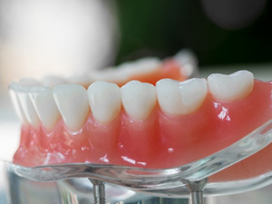 Dentures sitting on a clear display stand that showcases the implants underneath
