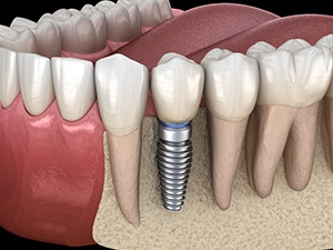 Animated dental implant supported dental crown