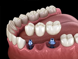 Animated dental implant supported fixed bridge