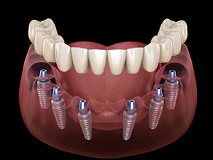 Animated dental implant supported denture