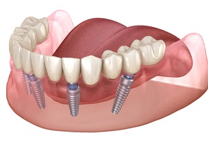 Diagram showing an implant denture in Denton