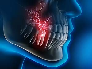 X-ray diagram of a toothaches