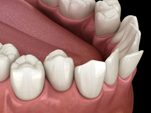 Illustration of a crowded teeth