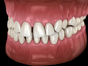 Illustration of a gapped teeth