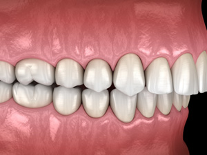 Illustration of an overbite