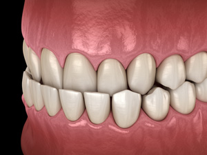 Illustration of an underbite