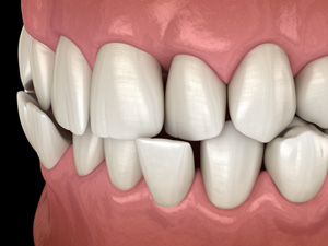 Illustration of a crossbite