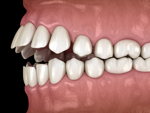 Illustration of an open bite
