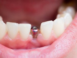 Close-up of dental implant in Denton, TX with healing cap