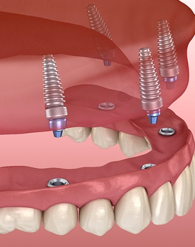 digital illustration of implant dentures in Denton