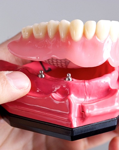 Dentist holding model of implant dentures in Denton