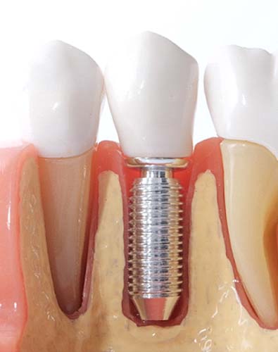 Model of dental implants in Denton