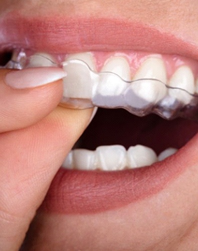 person putting an Invisalign aligner over their teeth