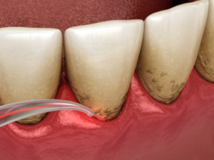 Digital image of dental laser removing bacteria