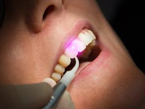 Close up of dentist using a dental laser on patient’s gums