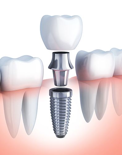 Animated dental implant supported dental crown