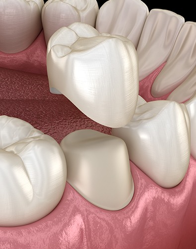 Animated rendering of dental crown placement
