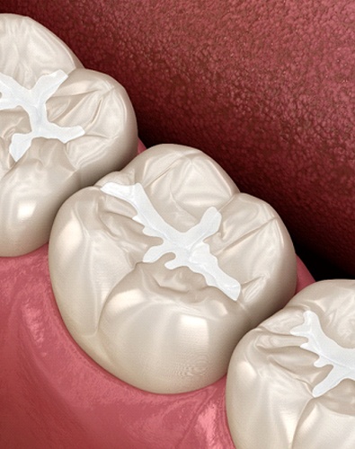 A digital image of three teeth on the lower arch with tooth-colored fillings