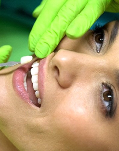 dentist placing a veneer on a woman’s tooth