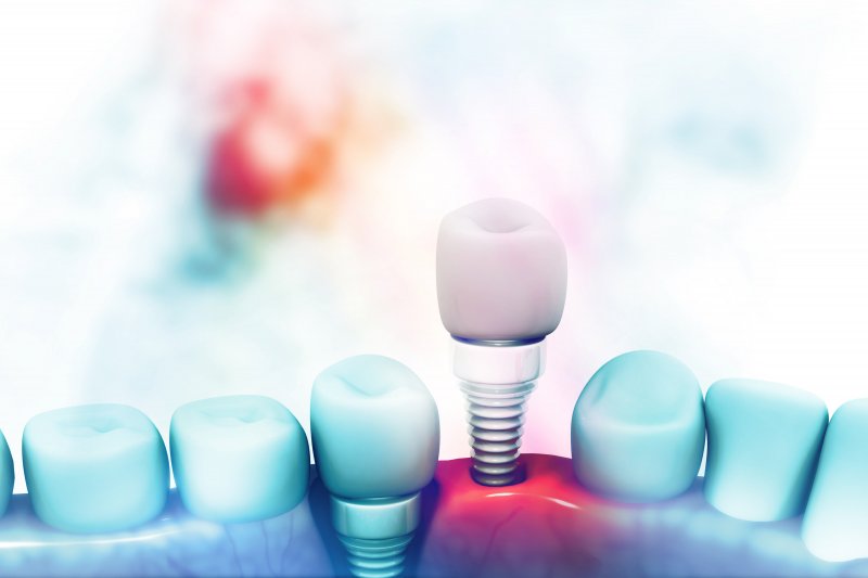 example of dental implants in Denton