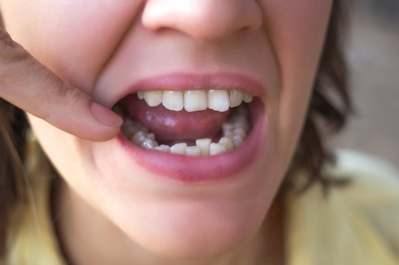 A woman pointing at her crooked teeth