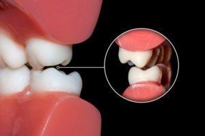 an example of the effects of teeth grinding