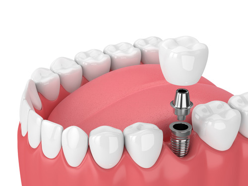 patient visiting dentist for implant consultation
