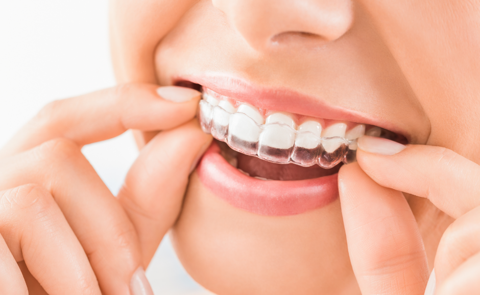 Woman fitting clear aligner