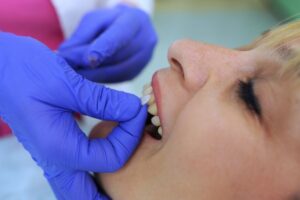 Dentist applying veneers to patient's front teeth.