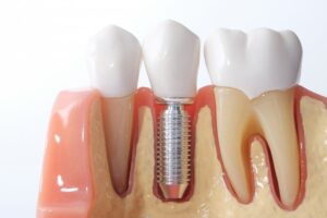 A single dental implant